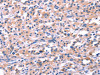 The image on the left is immunohistochemistry of paraffin-embedded Human thyroid cancer tissue using CSB-PA722618 (FEM1B Antibody) at dilution 1/20, on the right is treated with synthetic peptide. (Original magnification: ×200)