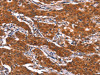 The image on the left is immunohistochemistry of paraffin-embedded Human gastic cancer tissue using CSB-PA942031 (FEM1B Antibody) at dilution 1/20, on the right is treated with synthetic peptide. (Original magnification: ×200)