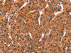 The image on the left is immunohistochemistry of paraffin-embedded Human liver cancer tissue using CSB-PA942031 (FEM1B Antibody) at dilution 1/20, on the right is treated with synthetic peptide. (Original magnification: ×200)