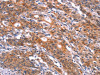 The image on the left is immunohistochemistry of paraffin-embedded Human gastic cancer tissue using CSB-PA400855 (FEM1A Antibody) at dilution 1/20, on the right is treated with synthetic peptide. (Original magnification: ×200)