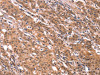 The image on the left is immunohistochemistry of paraffin-embedded Human gastic cancer tissue using CSB-PA077924 (FGF22 Antibody) at dilution 1/20, on the right is treated with synthetic peptide. (Original magnification: ×200)