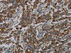 The image on the left is immunohistochemistry of paraffin-embedded Human liver cancer tissue using CSB-PA285771 (CFLAR Antibody) at dilution 1/20, on the right is treated with synthetic peptide. (Original magnification: ×200)