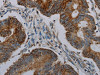 The image on the left is immunohistochemistry of paraffin-embedded Human colon cancer tissue using CSB-PA285771 (CFLAR Antibody) at dilution 1/20, on the right is treated with synthetic peptide. (Original magnification: ×200)