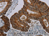 The image on the left is immunohistochemistry of paraffin-embedded Human colon cancer tissue using CSB-PA877207 (CFLAR Antibody) at dilution 1/20, on the right is treated with synthetic peptide. (Original magnification: ×200)