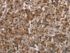 The image on the left is immunohistochemistry of paraffin-embedded Human liver cancer tissue using CSB-PA327117 (CFLAR Antibody) at dilution 1/20, on the right is treated with synthetic peptide. (Original magnification: ×200)