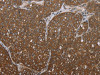 The image on the left is immunohistochemistry of paraffin-embedded Human ovarian cancer tissue using CSB-PA105517 (FOLH1B Antibody) at dilution 1/30, on the right is treated with synthetic peptide. (Original magnification: ×200)