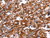 The image on the left is immunohistochemistry of paraffin-embedded Human thyroid cancer tissue using CSB-PA778804 (SLC6A1 Antibody) at dilution 1/25, on the right is treated with synthetic peptide. (Original magnification: ×200)
