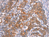 The image on the left is immunohistochemistry of paraffin-embedded Human gastric cancer tissue using CSB-PA778804 (SLC6A1 Antibody) at dilution 1/25, on the right is treated with synthetic peptide. (Original magnification: ×200)