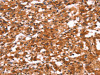 The image on the left is immunohistochemistry of paraffin-embedded Human thyroid cancer tissue using CSB-PA522630 (GABRA1 Antibody) at dilution 1/30, on the right is treated with synthetic peptide. (Original magnification: ×200)