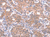 The image on the left is immunohistochemistry of paraffin-embedded Human gastric cancer tissue using CSB-PA522630 (GABRA1 Antibody) at dilution 1/30, on the right is treated with synthetic peptide. (Original magnification: ×200)
