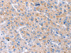 The image on the left is immunohistochemistry of paraffin-embedded Human liver cancer tissue using CSB-PA063689 (GAS1 Antibody) at dilution 1/20, on the right is treated with synthetic peptide. (Original magnification: ×200)