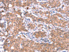 The image on the left is immunohistochemistry of paraffin-embedded Human gastric cancer tissue using CSB-PA593948 (GAS8 Antibody) at dilution 1/30, on the right is treated with synthetic peptide. (Original magnification: ×200)