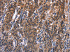 The image on the left is immunohistochemistry of paraffin-embedded Human gastric cancer tissue using CSB-PA781220 (R3HCC1L Antibody) at dilution 1/40, on the right is treated with synthetic peptide. (Original magnification: ×200)