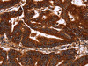 The image on the left is immunohistochemistry of paraffin-embedded Human colon cancer tissue using CSB-PA132284 (GCKR Antibody) at dilution 1/50, on the right is treated with synthetic peptide. (Original magnification: ×200)