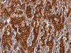 The image on the left is immunohistochemistry of paraffin-embedded Human gastric cancer tissue using CSB-PA132284 (GCKR Antibody) at dilution 1/50, on the right is treated with synthetic peptide. (Original magnification: ×200)