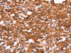 The image on the left is immunohistochemistry of paraffin-embedded Human thyroid cancer tissue using CSB-PA177709 (GLS Antibody) at dilution 1/15, on the right is treated with synthetic peptide. (Original magnification: ×200)