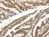 The image on the left is immunohistochemistry of paraffin-embedded Human esophagus cancer tissue using CSB-PA437630 (GPD2 Antibody) at dilution 1/20, on the right is treated with synthetic peptide. (Original magnification: ×200)