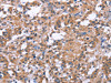The image on the left is immunohistochemistry of paraffin-embedded Human thyroid cancer tissue using CSB-PA977414 (SLC52A1 Antibody) at dilution 1/40, on the right is treated with synthetic peptide. (Original magnification: ×200)