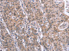 The image on the left is immunohistochemistry of paraffin-embedded Human gastric cancer tissue using CSB-PA977414 (SLC52A1 Antibody) at dilution 1/40, on the right is treated with synthetic peptide. (Original magnification: ×200)
