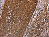 The image on the left is immunohistochemistry of paraffin-embedded Human cervical cancer tissue using CSB-PA223860 (GUK1 Antibody) at dilution 1/40, on the right is treated with synthetic peptide. (Original magnification: ×200)