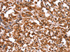 The image on the left is immunohistochemistry of paraffin-embedded Human thyroid cancer tissue using CSB-PA247916 (GUK1 Antibody) at dilution 1/50, on the right is treated with synthetic peptide. (Original magnification: ×200)