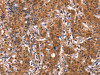 The image on the left is immunohistochemistry of paraffin-embedded Human gastric cancer tissue using CSB-PA247916 (GUK1 Antibody) at dilution 1/50, on the right is treated with synthetic peptide. (Original magnification: ×200)