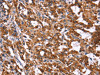 The image on the left is immunohistochemistry of paraffin-embedded Human thyroid cancer tissue using CSB-PA784614 (HACE1 Antibody) at dilution 1/40, on the right is treated with synthetic peptide. (Original magnification: ×200)