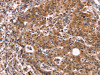 The image on the left is immunohistochemistry of paraffin-embedded Human gastric cancer tissue using CSB-PA784614 (HACE1 Antibody) at dilution 1/40, on the right is treated with synthetic peptide. (Original magnification: ×200)