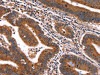 The image on the left is immunohistochemistry of paraffin-embedded Human colon cancer tissue using CSB-PA223356 (HACE1 Antibody) at dilution 1/50, on the right is treated with synthetic peptide. (Original magnification: ×200)