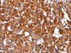 The image on the left is immunohistochemistry of paraffin-embedded Human thyroid cancer tissue using CSB-PA547529 (HAS1 Antibody) at dilution 1/30, on the right is treated with synthetic peptide. (Original magnification: ×200)
