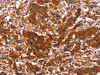 The image on the left is immunohistochemistry of paraffin-embedded Human gastric cancer tissue using CSB-PA547529 (HAS1 Antibody) at dilution 1/30, on the right is treated with synthetic peptide. (Original magnification: ×200)