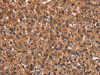 The image on the left is immunohistochemistry of paraffin-embedded Human liver cancer tissue using CSB-PA038349 (HINT1 Antibody) at dilution 1/30, on the right is treated with synthetic peptide. (Original magnification: ×200)