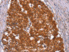 The image on the left is immunohistochemistry of paraffin-embedded Human gastic cancer tissue using CSB-PA925533 (HINT1 Antibody) at dilution 1/50, on the right is treated with synthetic peptide. (Original magnification: ×200)