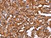 The image on the left is immunohistochemistry of paraffin-embedded Human thyroid cancer tissue using CSB-PA925533 (HINT1 Antibody) at dilution 1/50, on the right is treated with synthetic peptide. (Original magnification: ×200)