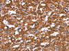 The image on the left is immunohistochemistry of paraffin-embedded Human thyroid cancer tissue using CSB-PA791283 (HLTF Antibody) at dilution 1/30, on the right is treated with synthetic peptide. (Original magnification: ×200)