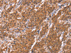 The image on the left is immunohistochemistry of paraffin-embedded Human gastric cancer tissue using CSB-PA791283 (HLTF Antibody) at dilution 1/30, on the right is treated with synthetic peptide. (Original magnification: ×200)