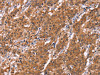 The image on the left is immunohistochemistry of paraffin-embedded Human gastric cancer tissue using CSB-PA791283 (HLTF Antibody) at dilution 1/30, on the right is treated with synthetic peptide. (Original magnification: ×200) The image on the left is immunohistochemistry of paraffin-embedded Human gastric cancer tissue using CSB-PA791283 (HLTF Antibody) at dilution 1/30, on the right is treated with synthetic peptide. (Original magnification: ×200)