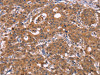 The image on the left is immunohistochemistry of paraffin-embedded Human gastic cancer tissue using CSB-PA133916 (HMGCS1 Antibody) at dilution 1/40, on the right is treated with synthetic peptide. (Original magnification: ×200)
