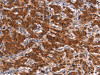 The image on the left is immunohistochemistry of paraffin-embedded Human gastic cancer tissue using CSB-PA187322 (HMGCS2 Antibody) at dilution 1/40, on the right is treated with synthetic peptide. (Original magnification: ×200)