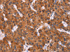 The image on the left is immunohistochemistry of paraffin-embedded Human liver cancer tissue using CSB-PA187322 (HMGCS2 Antibody) at dilution 1/40, on the right is treated with synthetic peptide. (Original magnification: ×200)