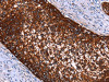 The image on the left is immunohistochemistry of paraffin-embedded Human cervical cancer tissue using CSB-PA045049 (HMGCS2 Antibody) at dilution 1/40, on the right is treated with synthetic peptide. (Original magnification: ×200)