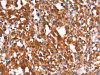 The image on the left is immunohistochemistry of paraffin-embedded Human thyroid cancer tissue using CSB-PA045049 (HMGCS2 Antibody) at dilution 1/40, on the right is treated with synthetic peptide. (Original magnification: ×200)