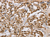 The image on the left is immunohistochemistry of paraffin-embedded Human thyroid cancer tissue using CSB-PA597489 (HNRNPL Antibody) at dilution 1/40, on the right is treated with synthetic peptide. (Original magnification: ×200)