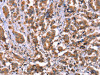 The image on the left is immunohistochemistry of paraffin-embedded Human breast cancer tissue using CSB-PA181107 (HRG Antibody) at dilution 1/50, on the right is treated with synthetic peptide. (Original magnification: ×200)