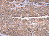 The image on the left is immunohistochemistry of paraffin-embedded Human ovarian cancer tissue using CSB-PA181107 (HRG Antibody) at dilution 1/50, on the right is treated with synthetic peptide. (Original magnification: ×200)