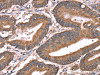 The image on the left is immunohistochemistry of paraffin-embedded Human colon cancer tissue using CSB-PA589788 (HRG Antibody) at dilution 1/50, on the right is treated with synthetic peptide. (Original magnification: ×200)