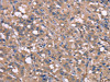 The image on the left is immunohistochemistry of paraffin-embedded Human thyroid cancer tissue using CSB-PA153691 (HP Antibody) at dilution 1/50, on the right is treated with synthetic peptide. (Original magnification: ×200)
