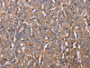 The image on the left is immunohistochemistry of paraffin-embedded Human gastric cancer tissue using CSB-PA153691 (HP Antibody) at dilution 1/50, on the right is treated with synthetic peptide. (Original magnification: ×200)