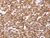 The image on the left is immunohistochemistry of paraffin-embedded Human thyroid cancer tissue using CSB-PA087383 (HSD17B1 Antibody) at dilution 1/40, on the right is treated with synthetic peptide. (Original magnification: ×200)