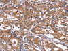 The image on the left is immunohistochemistry of paraffin-embedded Human gastric cancer tissue using CSB-PA044365 (HSD17B1 Antibody) at dilution 1/40, on the right is treated with synthetic peptide. (Original magnification: ×200)